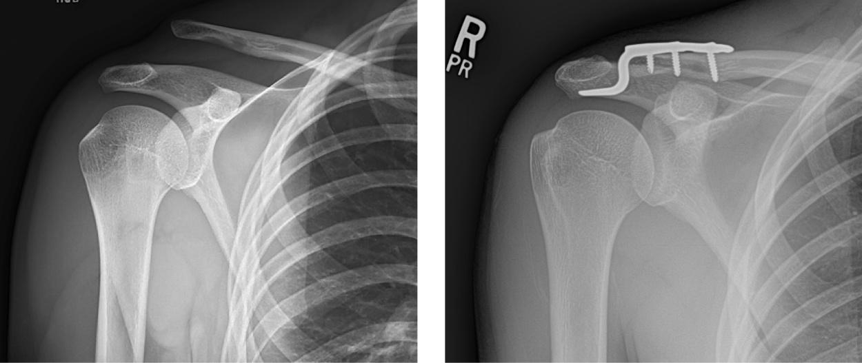 AC-joint-before-after